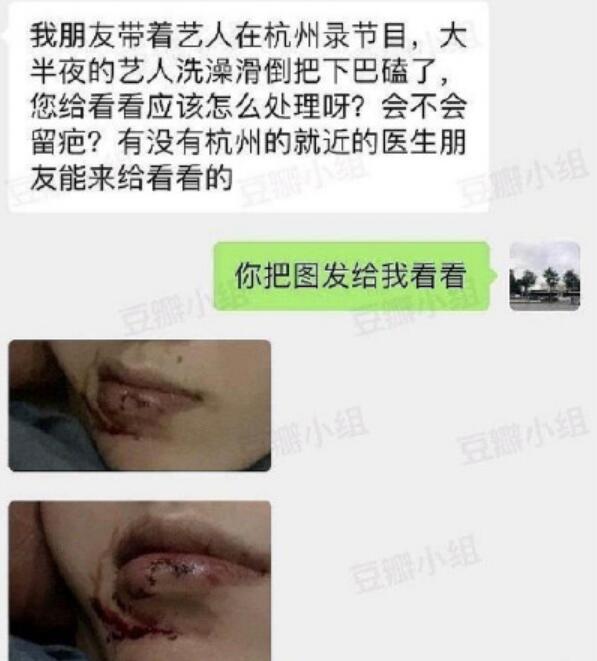 网曝范丞丞洗澡摔倒什么情况？下巴伤痕明显会留疤吗