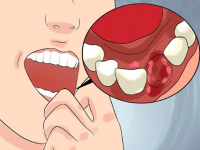 正规医院种一颗牙要多少钱？种植牙多少钱一颗2021表