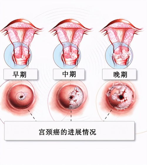 hpv哪几个型号最难治