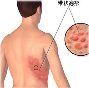 超90%成人体内潜伏带状疱疹