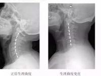 颈托对颈椎有什么好处,佩戴颈托对颈椎有什么样的作用？如何正确的佩戴颈托？