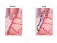 60岁以上不建议做心脏搭桥,64岁大伯冠心病做心脏搭桥手术，要开20多厘米的刀口？不，专家说5厘米就行