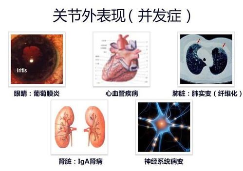 强直性脊柱炎6个地方疼