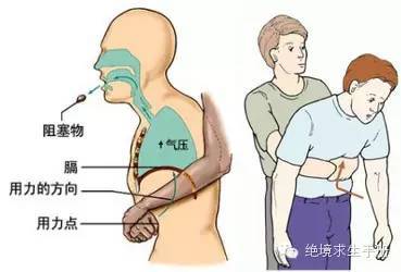 噎食海姆立克急救法