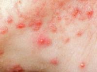 带状疱疹和水痘,带状疱疹和水痘有什么关联