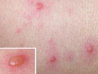 水痘是怎么引起的,肾炎是怎么引起的 7个原因容易引起肾炎