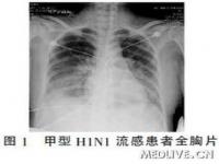 甲型流感症状,甲型NINI的症状