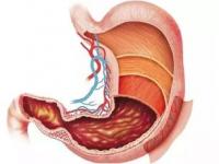 胃癌是什么原因引起的_胃癌是什么原因引起的病