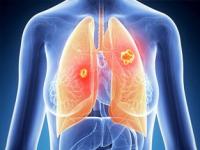 早期肺癌大多没有症状_多数肺癌早期没症状 早筛查是关键