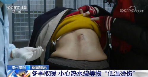 男子捂热水袋入睡被低温烫熟_捂着热水袋睡着了没感觉，男子醒来发现小腿被低温烫熟，医生：愈合极慢