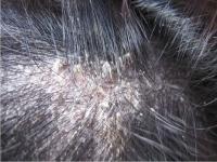 湿发睡觉会导致脂溢性皮炎_别再湿着头发睡觉了 脱发头屑都与它有关