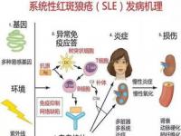 我国红斑狼疮患病率世界第二_我国红斑狼疮患病率世界第二 哪些人容易被盯上？