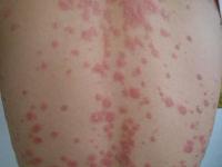 红斑狼疮是一种什么病会有哪些症状_红斑狼疮的潜伏期有多久