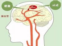 脑血管疾病发病后抓住黄金救治4.5小时_“桑拿天”需警惕脑血管疾病 突发脑卒中应抓住6小时救治“黄金时间”