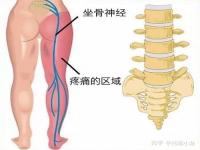 坐骨神经痛怎样锻炼_坐骨神经痛锻炼方法有哪些