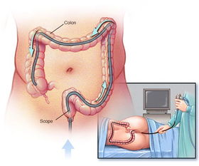 肠镜检查别晚于45岁_专家呼吁：过了45岁，一定要做一次肠镜，管你五年、十年没问题