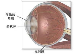 角膜移植手术后的眼缝合线_角膜移植“胶粘”将取代缝线