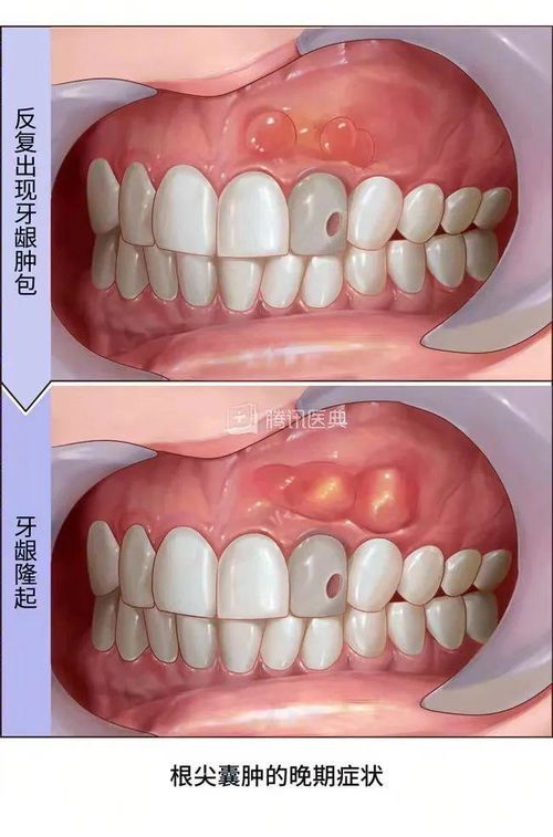 牙龈肿痛出血不一定是上火_牙龈肿痛出血，真不是“上火”！拖久了可能要开刀