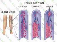 久坐不动或导致下肢深静脉血栓_老人久坐不动 易患深静脉血栓