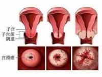 早期宫颈癌可能没有症状_宫颈癌早期不痛不痒，若出现这5个症状，建议检查下子宫