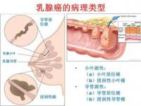 如何早期发现隐匿性乳腺癌_「专家说」王昕医生：什么是隐匿性乳腺癌