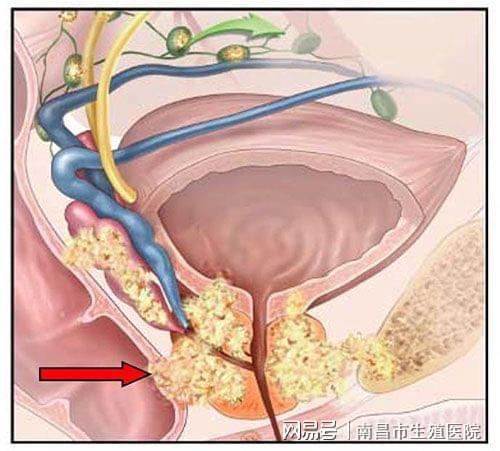 为何前列腺癌一发现就是晚期_前列腺癌为什么往往一发现就是晚期？