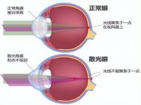 散光的原理和形成原因_为什么会散光