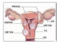 子宫肌瘤有可能是吃出来的_子宫肌瘤是吃出来的，这3种食物是元凶，劝你还是不要往嘴巴塞了