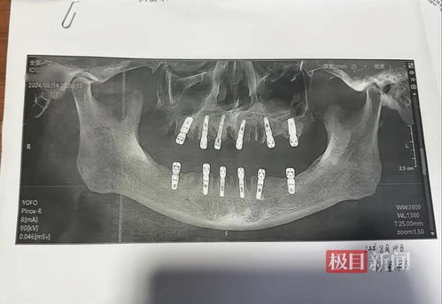 医院回应男子1天拔23颗牙后去世_男子一次性拔牙23颗种植12颗，13天后去世！当地卫健局回应