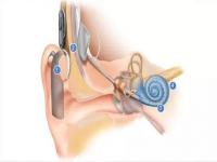 做人工耳蜗需要花多少钱_一般人工耳蜗手术各年龄段都能报销吗