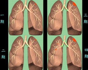 肺癌早期症状通常不明显_肺癌早期5个症状大盘点 应及时发现及时治疗
