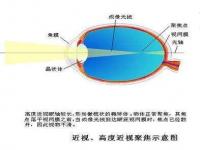 眼睛多少度算近视_眼睛视力多少算近视