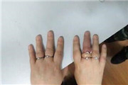 女子被5枚戒指“咬手” 手指严重肿胀