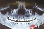 眼眶下面长牙齿 系乳牙不掉导致恒牙在颌骨内游走