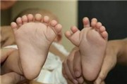 男婴长31个手指脚趾为先天肢体畸形 现已切除即将恢复【图】