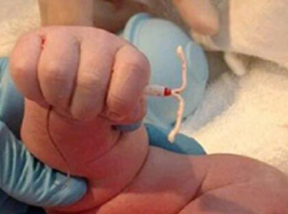 新生儿手握避孕环出生！完美诠释人生在自己手上！