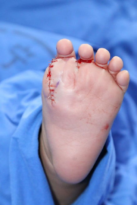 男婴长31个手指脚趾为先天肢体畸形 现已切除即将恢复【图】