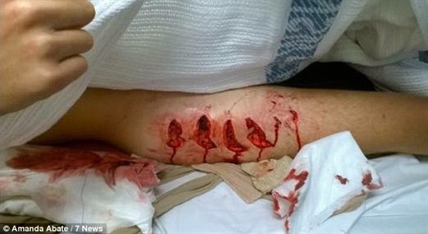 17岁少年年大腿遭大白鲨撕咬 留下四个大血印