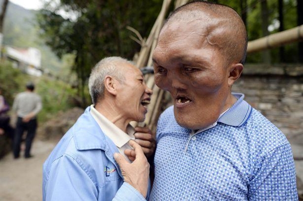 53岁男子患上了怪病脸部肿大似外星人