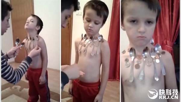 5岁小男孩被称为“磁铁人” 专家：皮肤太油腻