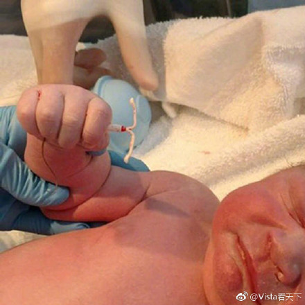 新生儿手握避孕环出生！完美诠释人生在自己手上！