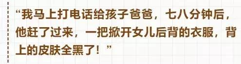 女孩摔倒在积水后大谬烧伤怎么回事   积水到底含有什么成分造成背部全黑