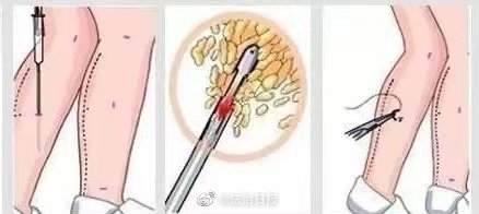 抽脂后大腿凹凸不平上厕所蹲不下 大腿抽脂凹陷能恢复吗?