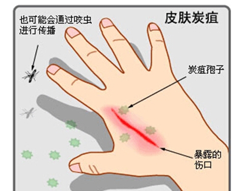 美在韩研究病毒毒性比炭疽菌强10万倍 炭疽杆菌能治好吗?