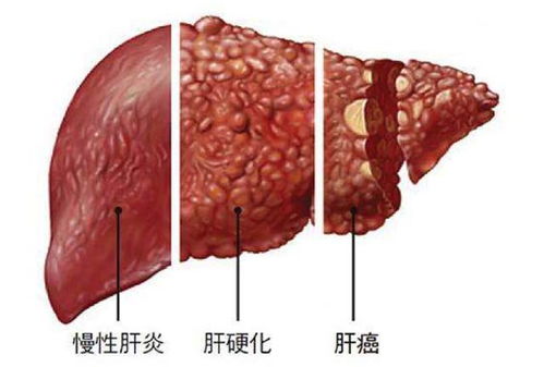 肝脏开始变硬有6种迹象