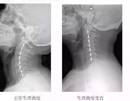 颈托对颈椎有什么好处