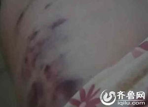 女子遭丈夫打断腰椎住院后被砍数刀_女子遭丈夫打断腰椎住院时再被砍伤 家属：曾两次转院抢救10小时