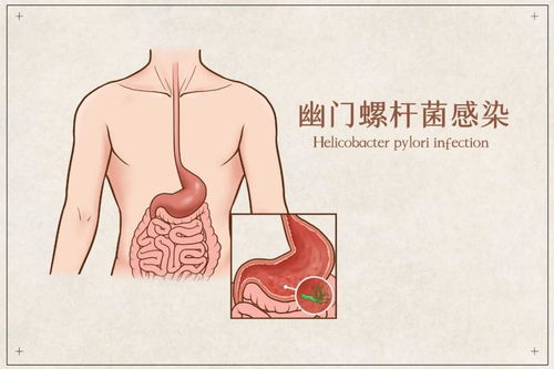 感染幽门螺杆菌患胃癌的比例约1%_感染幽门螺杆菌出现胃癌的几率有多高？医生：这些患者风险相当高