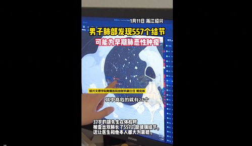 浙江一男子肺部发现557个结节_知名演员发文，家人同事被“打扰”！网友：最担心的事......