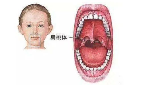 官方调查10岁女孩扁桃体微创手术死亡_10岁女孩扁桃体微创手术身亡，卫健部门启动调查